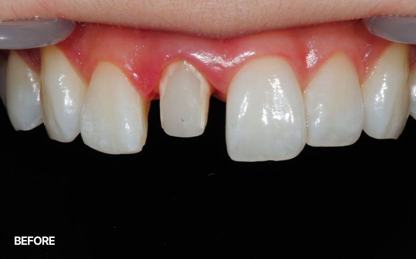 before