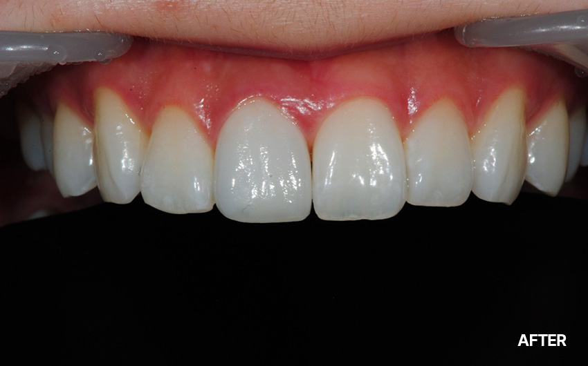 after