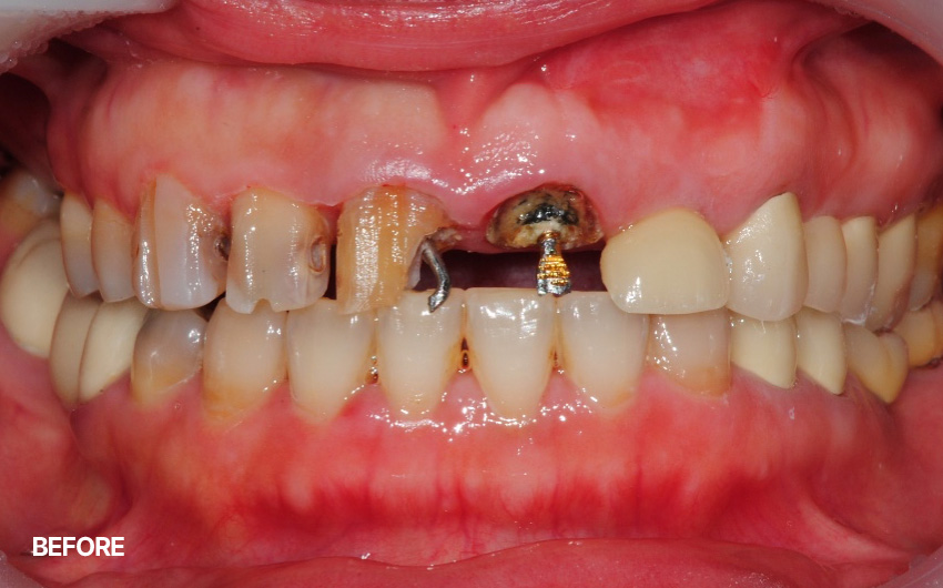 before