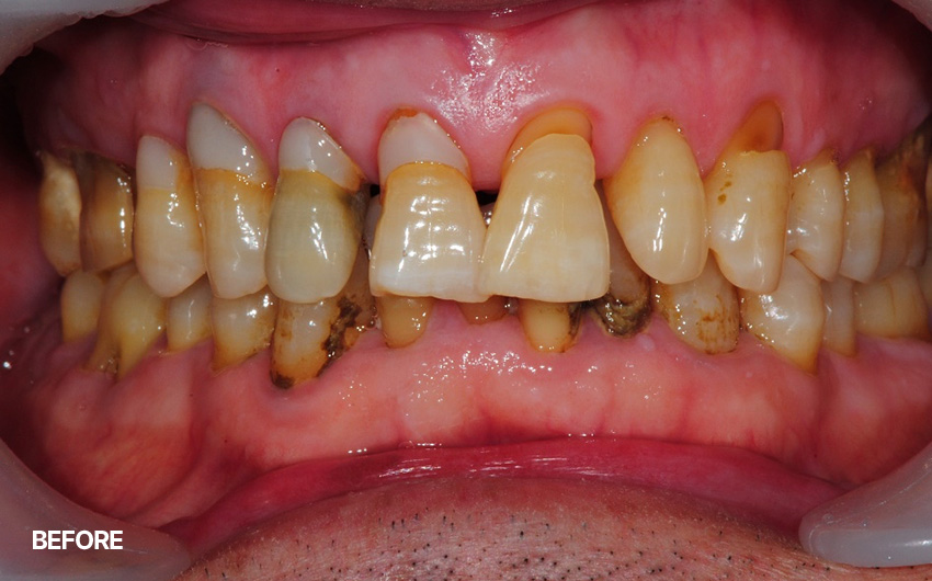 before
